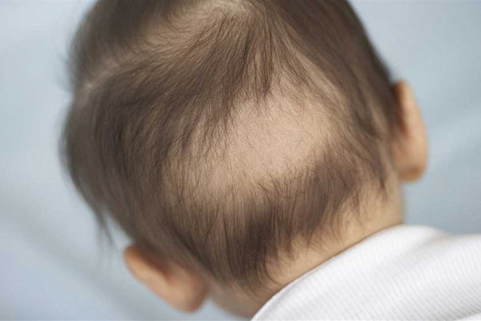 أسباب تساقط الشعر عند الأطفال